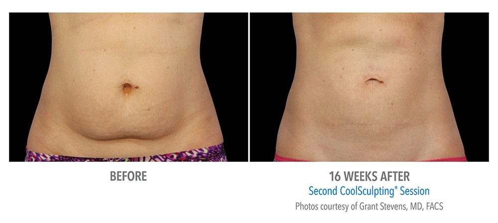 Coolsculpting Results Costa Rica